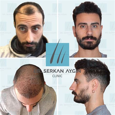 dr serkan aygin clinic reviews|Dr. Serkan Aygin Hair Transplant Clinic Reviews .